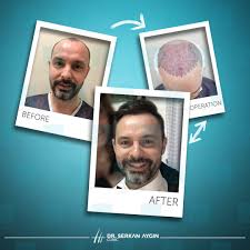 Hair Transplantation Hair Transplant Before After Hair Beard Transplant