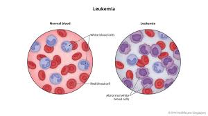Image result for Leukemia