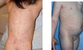 Tuberculosis cutis indurativa add pharm action registry number cas type 1 name nlm classification # previous indexing see also consider also public mesh note 91; Dermatovenerologija Atlas I Skripta Pdf Pdf Txt