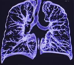 Lung cancer is a common cause of finger clubbing; Can You Be Misdiagnosed With Lung Cancer Pintas Mullins Law Firm