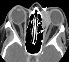 Treated her nodal involvement as small cell lung cancer. Sarcoidosis The Master Mimicker Sciencedirect