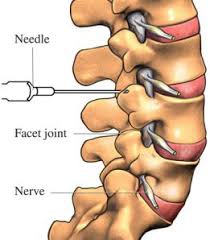 The facet joints in the spine help you to move and twist. Pain Management Facet Joint Injection