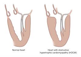 Image result for Cardiomyopathy