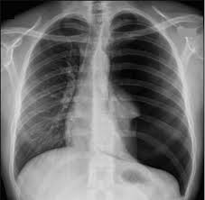 Image result for Open Pneumothorax