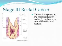 Some commonly refer to the disease as belly or abdominal cancer. Carcinoma Rectum Radiotherapy Perspective
