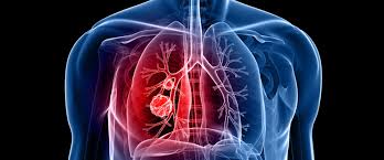 Symptoms include breathing difficulty, cough, mucus (sputum). Ù…Ø§ Ù‡Ùˆ Ø³Ø±Ø·Ø§Ù† Ø§Ù„Ø±Ø¦Ø©