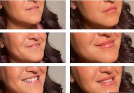 your lips, but better 👏🏼 hydrated and perfectly kissed thanks to juvederm  Volbella