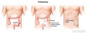 Ct is notoriously unreliable for polyps or early stage tumors. Department Of Surgery Colon Cancer