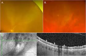 Ocular vs neurosyphilis. are they the same? A guide to investigation and  management | Eye