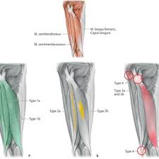 They most often occur at the middle of the back of the thigh where the muscle joins its tendon or at the base of the buttocks. Pdf Terminology And Classification Of Muscle Injuries In Sport The Munich Consensus Statement