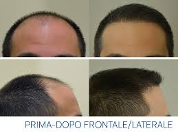 Tutte le immagini prima e dopo del trapianto capelli dei nostri clienti che hanno deciso di condividere la loro esperienza con istituto helvetico sanders. Costo Trapianto Capelli In Italia Come Funziona Prezzi E Tempi