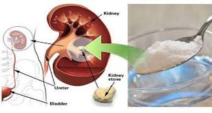 By Using 1 Teaspoon Of Baking Soda You Can Repair Your Damaged Kidney Naturally Kidney Health Kidney Damage Baking Soda