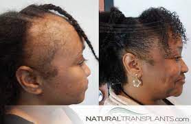 Hair Restoration For Women Hairrestorationforwomen Sunday Sundayfunday Sundayvibes Sundays Sundaymood Hai Hair Doctor Hair Restoration Hair Loss Women