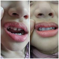 Gigi palsu, bagan datoh, negeri perak. Gigi Palsu Temptooth Temporary Tooth Lem Tambal Gigi Patah Isi 25 Butir Berlubang Bolong Renggang Ompong Bisa Buat Sendiri Lazada Indonesia