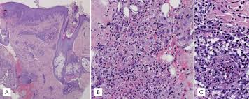 Image result for Deep Folliculitis