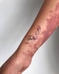 Birthmark On Leg Meaning A Cherry Blossom And Hallie S Port Wine Stain In 2020 Port Wine Stain Port Wine Stain Birthmark Wine Stains