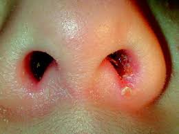 Nasal vestibulitis refers to bacterial infection in the nasal vestibule (front part of the nasal cavity). Nasal Vestibulitis And Nasal Furunculosis And Mucormycosis Springerlink
