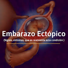 Embarazo Ectopico