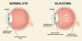 Image result for Intraocular Pressure