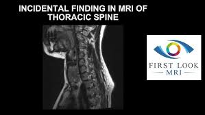 Image result for Incidental Imaging Finding