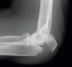 Olecranon synonyms, olecranon pronunciation, olecranon translation, english dictionary definition of olecranon. Olecranon Fractures The Shoulder And Elbow Clinic