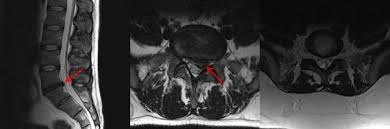 Eine mrt vom rücken in den bereichen hws, bws, lws eignet sich, um bei schmerzen in diesen bereichen diagnosen zu stellen. Universitatsklinikum Des Saarlandes Bandscheibenvorfalle