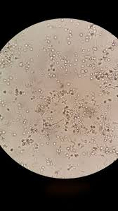 Here You Can See Lots Of Yeast And Long Fungal Elements Yep This Is A Yeast Infection That A Lab Scientist Discovered Yeast Infection Bloodstream Antibiotic