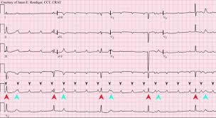 We did not find results for: Atrioventricular Block Knowledge Amboss