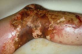 Thi s review article aims to discuss the. Burns Clinical Advisor