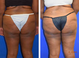Buttocks the buttocks i adjusted to make them be squished against the ground. Brazilian Butt Lift Mobile Traditional Butt Lift Gulf Coast