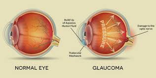 Image result for Intraocular Pressure