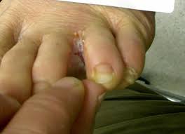 If skin breakdown occurs, the rash may weep fluid and become infected. Intertrigo Definition And Synonyms Of Intertrigo In The German Dictionary