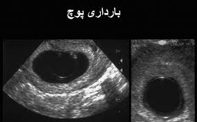 منظور از بارداري مولار يا (پوچ) چيست؟