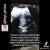 Ini karena bayi sedang berusaha memutar tubuhnya untuk memposisikan kepala yang tadinya di atas, agar berada di bawah mendekati vagina. 1