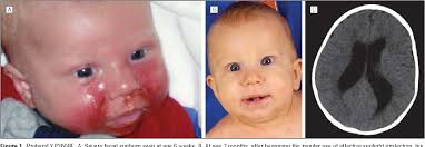 PDF] Unexpected occurrence of xeroderma pigmentosum in an uncle and nephew. 