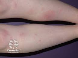 Image result for erythema nodosum