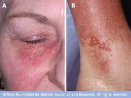 Image result for dermatitis contacta