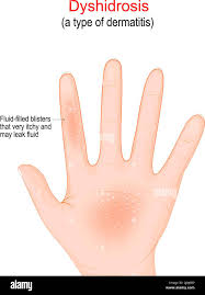 Image result for dyshidrosis