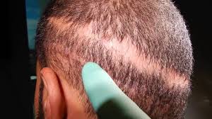 Repair procedure needs a lot of personal attention and planning of hair restoration surgeon and unfortunately bad hair transplantation. Bad Hair Transplants Leave A Bad Scar Top Hair Transplant Surgeons Https Youtu Be Bg6e5 Lq9o Hair Transplant Bad Hair Hair Clinic
