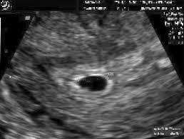Image result for First Trimester Ultrasound