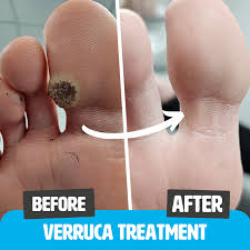 Image result for verruca