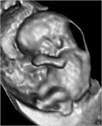 What is a nuchal translucency scan? Screen All Pregnancies For Down Syndrome Doctors Say The New York Times