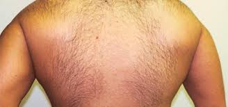 Laser hair removal costs might creep up as additional factors are added. Laser Hair Removal Bellevue Kirkland Best Laser Hair Removal