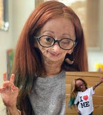 💫 The Girl Who Aged Too Fast — But Never Stopped Smiling Her name was  Adalia Rose, and she lived life at a speed the world couldn't keep up with.  Born with