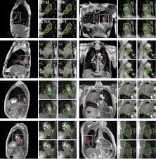 You can also use our free templates as google slides themes. Tumour Auto Contouring On 2d Cine Mri For Locally Advanced Lung Cancer A Comparative Study Radiotherapy And Oncology