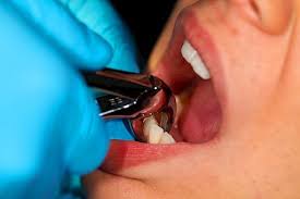 6.1 draining a gum abscess. Care Checklist After Tooth Extraction Tempe Dentist 85283
