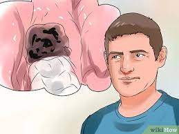 See full list on wikihow.com How To Remove Food From Extracted Wisdom Teeth Sockets 14 Steps