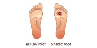 It's one of the most common complications experienced by people living with diabetes. Diabetic Foot Ulcers Symptoms Causes And Risk Factors Pristyn Care