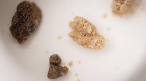 Roller Coasters Could Help People Pass Kidney Stones The Atlantic Kidney stones develop when high levels of salt and other minerals in the urine stick together. pass kidney stones