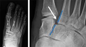 Learn vocabulary, terms and more with flashcards, games and other moi for lisfranc injuries? Lisfranc Injury Orthopaedic Trauma Association Ota